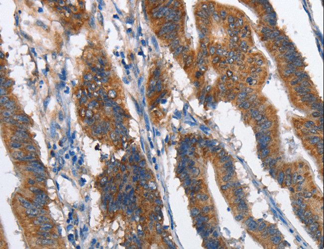 CMT2 / MAD2L1BP Antibody - Immunohistochemistry of paraffin-embedded Human lung cancer using MAD2L1BP Polyclonal Antibody at dilution of 1:60.