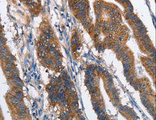 CMT2 / MAD2L1BP Antibody - Immunohistochemistry of paraffin-embedded Human lung cancer using MAD2L1BP Polyclonal Antibody at dilution of 1:60.