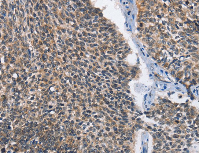 CMT2 / MAD2L1BP Antibody - Immunohistochemistry of paraffin-embedded Human lung cancer using MAD2L1BP Polyclonal Antibody at dilution of 1:60.