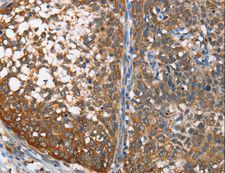 CMT2 / MAD2L1BP Antibody - Immunohistochemistry of paraffin-embedded Human cervical cancer using MAD2L1BP Polyclonal Antibody at dilution of 1:65.