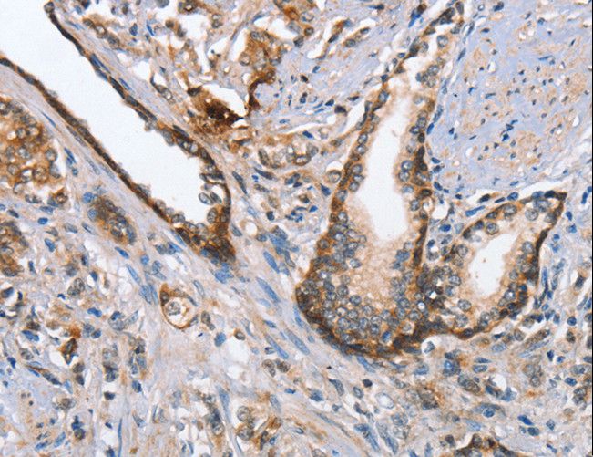 CMT2 / MAD2L1BP Antibody - Immunohistochemistry of paraffin-embedded Human prostate cancer using MAD2L1BP Polyclonal Antibody at dilution of 1:65.