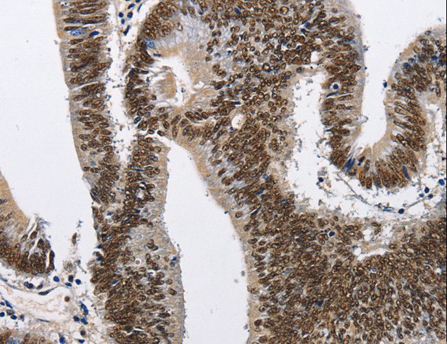 CMTM2 Antibody - Immunohistochemistry of paraffin-embedded Human esophagus cancer using CMTM2 Polyclonal Antibody at dilution of 1:60.