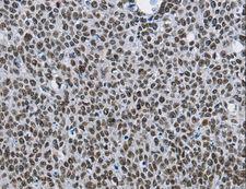 CMTM2 Antibody - Immunohistochemistry of paraffin-embedded Human colon cancer using CMTM2 Polyclonal Antibody at dilution of 1:60.
