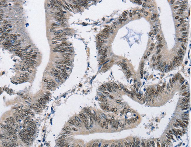 CMTM2 Antibody - Immunohistochemistry of paraffin-embedded Human colon cancer using CMTM2 Polyclonal Antibody at dilution of 1:60.