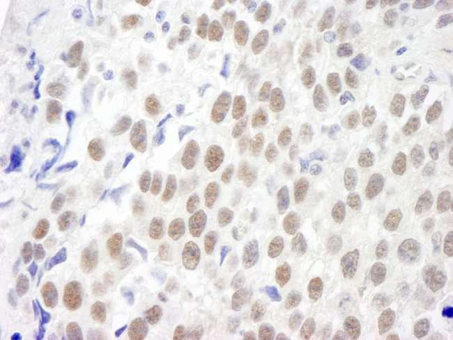 CMTR1 / FTSJD2 Antibody - Detection of Human KIAA0082 by Immunohistochemistry. Sample: FFPE section of human seminoma. Antibody: Affinity purified rabbit anti-KIAA0082 used at a dilution of 1:250.