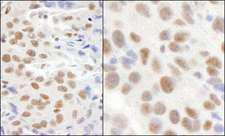 CMTR1 / FTSJD2 Antibody - Detection of Human and Mouse KIAA0082 by Immunohistochemistry. Sample: FFPE section of human breast carcinoma (left) and mouse CT26 colon carcinoma (right). Antibody: Affinity purified rabbit anti-KIAA0082 used at a dilution of 1:1000 (1 ug/ml). Detection: DAB.