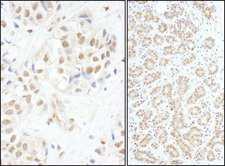 cmyb Antibody - Detection of Human c-Myb by Immunohistochemistry. Sample: FFPE section of human breast carcinoma (left) and salivary gland (right). Antibody: Affinity purified rabbit anti-c-Myb antibody used at a dilution of 1:5000 (0.2 ug/ml) and 1:1000 (1 ug/ml). Detection: DAB.