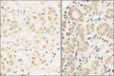 cmyb Antibody - Detection of Human c-Myb by Immunohistochemistry. Sample: FFPE section of human breast carcinoma (left) and salivary gland (right). Antibody: Affinity purified rabbit anti-c-Myb used at a dilution of 1:1000 (1 ug/ml). Detection: DAB.