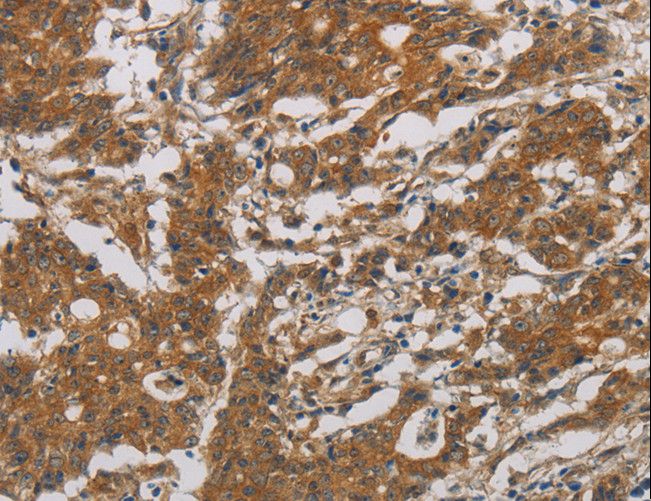 CNDP1 Antibody - Immunohistochemistry of paraffin-embedded Human gastric cancer using CNDP1 Polyclonal Antibody at dilution of 1:30.