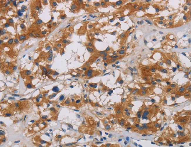 CNDP1 Antibody - Immunohistochemistry of paraffin-embedded Human thyroid cancer using CNDP1 Polyclonal Antibody at dilution of 1:30.