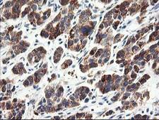 CNDP2 Antibody - IHC of paraffin-embedded Carcinoma of Human lung tissue using anti-CNDP2 mouse monoclonal antibody.