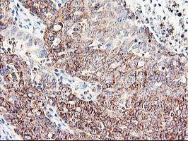 CNDP2 Antibody - IHC of paraffin-embedded Adenocarcinoma of Human ovary tissue using anti-CNDP2 mouse monoclonal antibody.