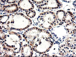 CNDP2 Antibody - IHC of paraffin-embedded Carcinoma of Human thyroid tissue using anti-CNDP2 mouse monoclonal antibody.