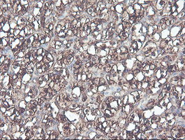 CNDP2 Antibody - IHC of paraffin-embedded Carcinoma of Human kidney tissue using anti-CNDP2 mouse monoclonal antibody.