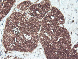 CNDP2 Antibody - IHC of paraffin-embedded Adenocarcinoma of Human ovary tissue using anti-CNDP2 mouse monoclonal antibody.