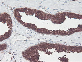 CNDP2 Antibody - IHC of paraffin-embedded Carcinoma of Human prostate tissue using anti-CNDP2 mouse monoclonal antibody.