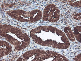 CNDP2 Antibody - IHC of paraffin-embedded Adenocarcinoma of Human endometrium tissue using anti-CNDP2 mouse monoclonal antibody.