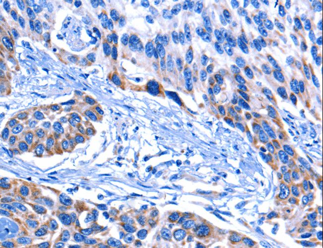 CNGA2 Antibody - Immunohistochemistry of paraffin-embedded Human esophagus cancer using CNGA2 Polyclonal Antibody at dilution of 1:25.