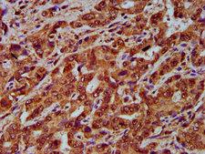 CNGB1 Antibody - Immunohistochemistry Dilution at 1:200 and staining in paraffin-embedded human liver cancer performed on a Leica BondTM system. After dewaxing and hydration, antigen retrieval was mediated by high pressure in a citrate buffer (pH 6.0). Section was blocked with 10% normal Goat serum 30min at RT. Then primary antibody (1% BSA) was incubated at 4°C overnight. The primary is detected by a biotinylated Secondary antibody and visualized using an HRP conjugated SP system.