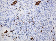 CNKSR3 Antibody - IHC of paraffin-embedded Adenocarcinoma of Human endometrium tissue using anti-CNKSR3 mouse monoclonal antibody.