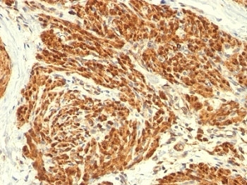 CNN1 / Calponin Antibody - Formalin-fixed, paraffin-embedded human uterus stained with Calponin antibody (CALP).  This image was taken for the unmodified form of this product. Other forms have not been tested.