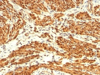 CNN1 / Calponin Antibody - Formalin-fixed, paraffin-embedded human uterus stained with Calponin antibody (CNN1/832 + CALP).  This image was taken for the unmodified form of this product. Other forms have not been tested.