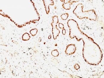 CNN1 / Calponin Antibody - Formalin-fixed, paraffin-embedded human breast carcinoma stained with Calponin antibody (CNN1/832 + CALP).  This image was taken for the unmodified form of this product. Other forms have not been tested.