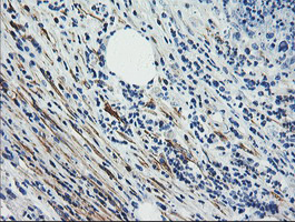 CNN2 Antibody - IHC of paraffin-embedded Carcinoma of Human pancreas tissue using anti-CNN2 mouse monoclonal antibody. (Heat-induced epitope retrieval by 10mM citric buffer, pH6.0, 100C for 10min).