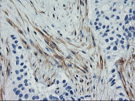 CNN2 Antibody - IHC of paraffin-embedded Carcinoma of Human bladder tissue using anti-CNN2 mouse monoclonal antibody. (Heat-induced epitope retrieval by 10mM citric buffer, pH6.0, 100C for 10min).