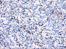CNN2 Antibody - IHC of paraffin-embedded Human lymphoma tissue using anti-CNN2 mouse monoclonal antibody. (Heat-induced epitope retrieval by 10mM citric buffer, pH6.0, 100C for 10min).