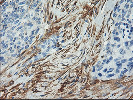 CNN2 Antibody - IHC of paraffin-embedded Adenocarcinoma of Human breast tissue using anti-CNN2 mouse monoclonal antibody. (Heat-induced epitope retrieval by 10mM citric buffer, pH6.0, 100C for 10min).
