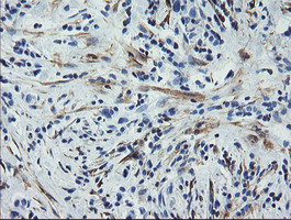 CNN2 Antibody - IHC of paraffin-embedded Carcinoma of Human lung tissue using anti-CNN2 mouse monoclonal antibody. (Heat-induced epitope retrieval by 10mM citric buffer, pH6.0, 100C for 10min).