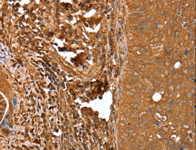 CNN3 Antibody - Immunohistochemistry of paraffin-embedded Human cervical cancer using CNN3 Polyclonal Antibody at dilution of 1:25.