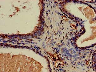 CNN3 Antibody - Immunohistochemistry of paraffin-embedded human prostate cancer using CNN3 Antibody at dilution of 1:100