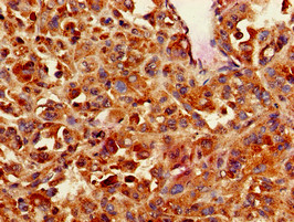 CNN3 Antibody - Immunohistochemistry of paraffin-embedded human melanoma cancer using CNN3 Antibody at dilution of 1:100