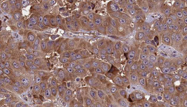 CNNM3 Antibody - 1:100 staining human liver carcinoma tissues by IHC-P. The sample was formaldehyde fixed and a heat mediated antigen retrieval step in citrate buffer was performed. The sample was then blocked and incubated with the antibody for 1.5 hours at 22°C. An HRP conjugated goat anti-rabbit antibody was used as the secondary.