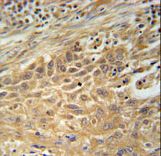 CNNM4 Antibody - CNNM4 Antibody immunohistochemistry of formalin-fixed and paraffin-embedded human lung carcinoma followed by peroxidase-conjugated secondary antibody and DAB staining.