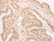 CNOT10 Antibody - Immunohistochemistry of paraffin-embedded Human thyroid cancer tissue  using CNOT10 Polyclonal Antibody at dilution of 1:50(×200)