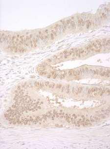 CNOT2 Antibody - Detection of Human CNOT2 by Immunohistochemistry. Sample: FFPE section of human colon carcinoma. Antibody: Affinity purified rabbit anti-CNOT2 used at a dilution of 1:250.