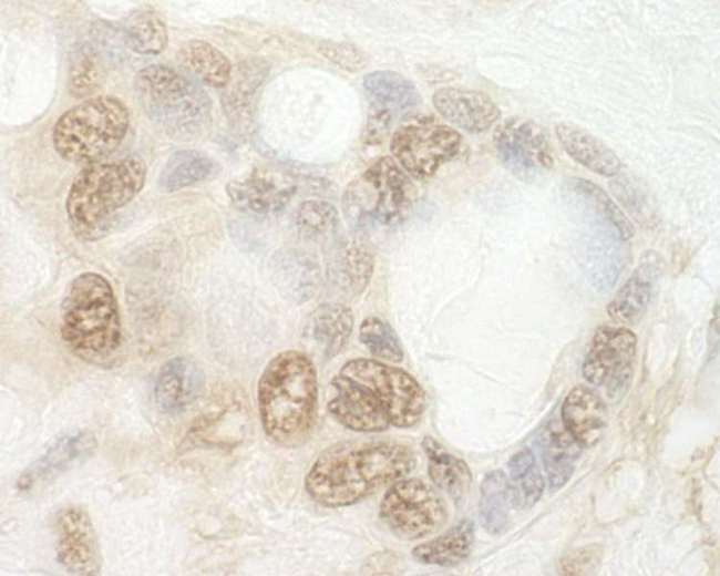 CNOT2 Antibody - Detection of Human CNOT2 by Immunohistochemistry. Sample: FFPE section of human ovarian carcinoma. Antibody: Affinity purified rabbit anti-CNOT2 used at a dilution of 1:250.