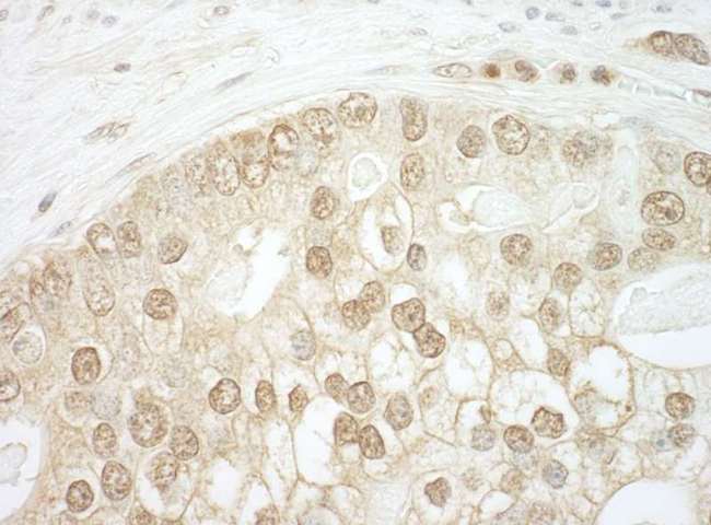 CNOT2 Antibody - Detection of Human CNOT2 by Immunohistochemistry. Sample: FFPE section of human prostate carcinoma. Antibody: Affinity purified rabbit anti-CNOT used at a dilution of 1:1000 (1 ug/ml).