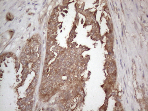 CNOT2 Antibody - Immunohistochemical staining of paraffin-embedded Adenocarcinoma of Human ovary tissue using anti-CNOT2 mouse monoclonal antibody. (Heat-induced epitope retrieval by 1mM EDTA in 10mM Tris buffer. (pH8.5) at 120°C for 3 min. (1:150)