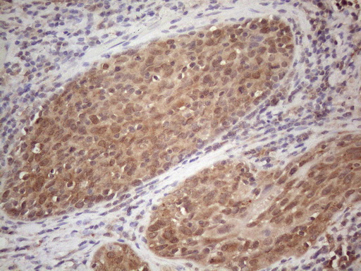 CNOT2 Antibody - Immunohistochemical staining of paraffin-embedded Carcinoma of Human bladder tissue using anti-CNOT2 mouse monoclonal antibody. (Heat-induced epitope retrieval by 1mM EDTA in 10mM Tris buffer. (pH8.5) at 120°C for 3 min. (1:150)