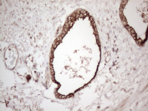 CNOT2 Antibody - Immunohistochemical staining of paraffin-embedded Carcinoma of Human prostate tissue using anti-CNOT2 mouse monoclonal antibody. (Heat-induced epitope retrieval by 1mM EDTA in 10mM Tris buffer. (pH8.5) at 120°C for 3 min. (1:150)