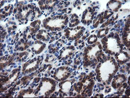 CNOT4 / CLONE243 Antibody - IHC of paraffin-embedded Carcinoma of Human thyroid tissue using anti-CNOT4 mouse monoclonal antibody.