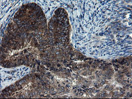 CNOT4 / CLONE243 Antibody - IHC of paraffin-embedded Adenocarcinoma of Human endometrium tissue using anti-CNOT4 mouse monoclonal antibody.