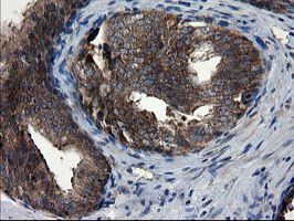 CNOT4 / CLONE243 Antibody - IHC of paraffin-embedded Carcinoma of Human prostate tissue using anti-CNOT4 mouse monoclonal antibody.