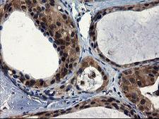 CNOT4 / CLONE243 Antibody - IHC of paraffin-embedded Adenocarcinoma of Human breast tissue using anti-CNOT4 mouse monoclonal antibody.