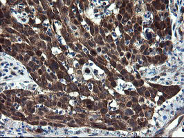 CNOT4 / CLONE243 Antibody - IHC of paraffin-embedded Carcinoma of Human lung tissue using anti-CNOT4 mouse monoclonal antibody.
