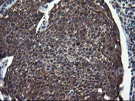 CNOT4 / CLONE243 Antibody - IHC of paraffin-embedded Carcinoma of Human bladder tissue using anti-CNOT4 mouse monoclonal antibody.